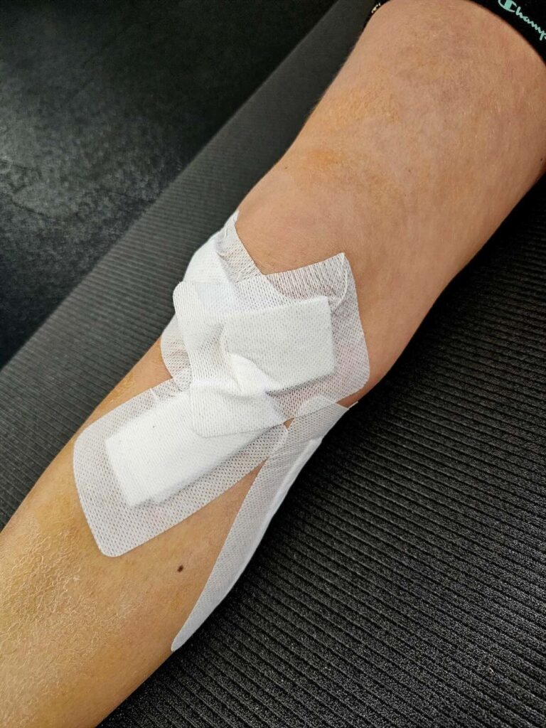 Złamanie wieloodłamowe kości piszczelowej i typu Schatzkera
